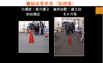 脳血管疾患(脳梗塞)