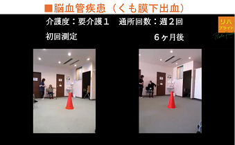 脳血管疾患(くも膜下出血)